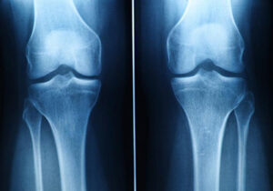 Articular Cartilage Injuries