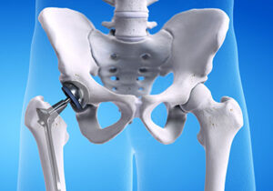 Joint Replacement