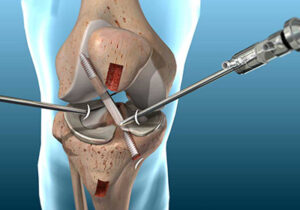 Ligament Reconstruction